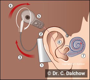 Illustration eines Cochlea-Implantats
