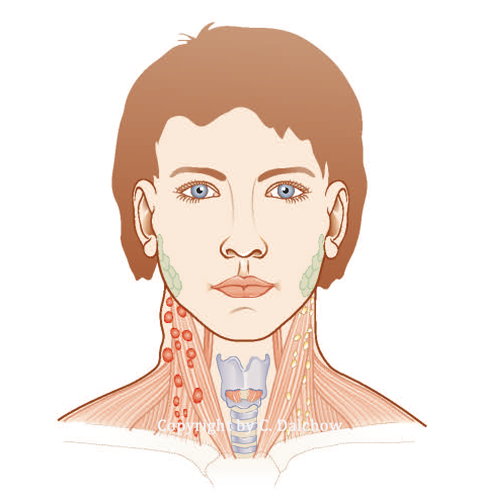 Darstellung entzündlich vergrößerter Lymphknoten