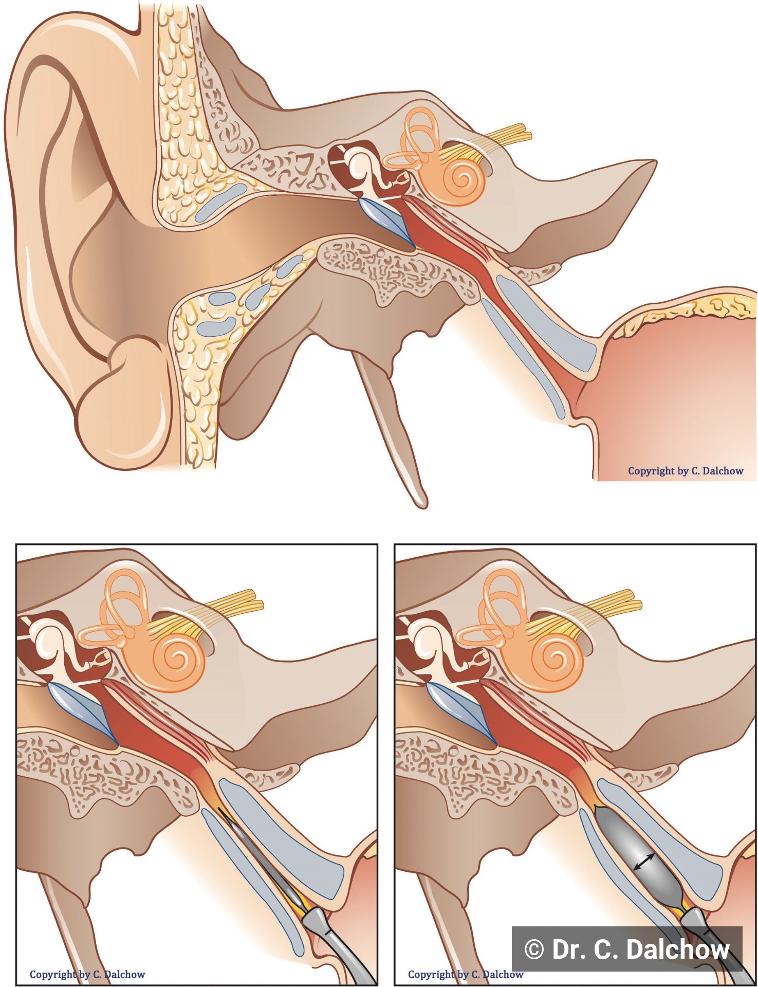 Übersicht der endoskopischen Dilatation der Tuba eustachii (EET) mit Darstellung der Ballondilatation