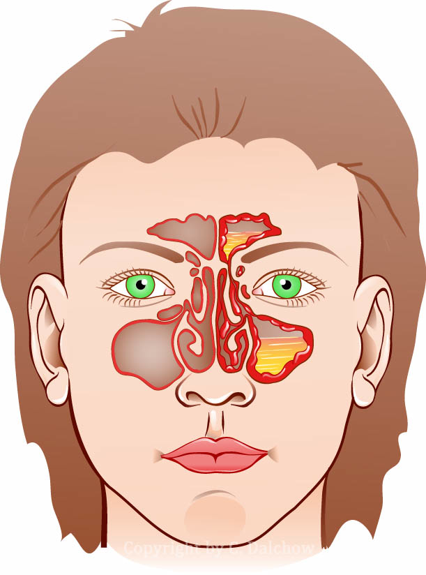 Illustration der Nasennebenhöhlen
